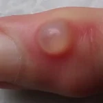Mucous Cysts of the Fingers