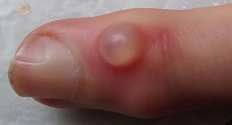 Mucous Cysts of the Fingers