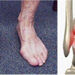 Osteoarthritis of the Ankle