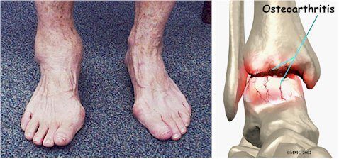 Osteoarthritis of the Ankle