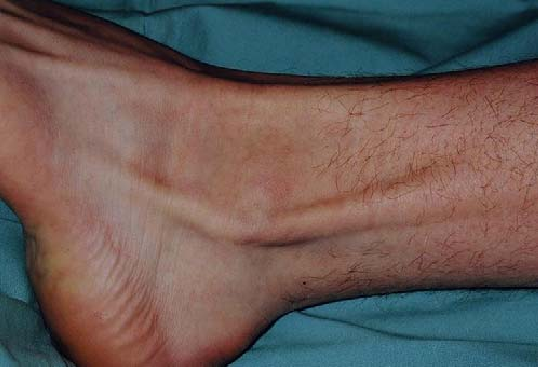 Peroneal Tendon Subluxation