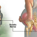 How to Cope With Sciatica Pain during Pregnancy