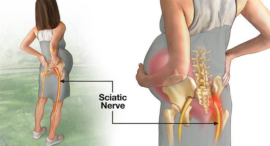 How to Cope With Sciatica Pain during Pregnancy