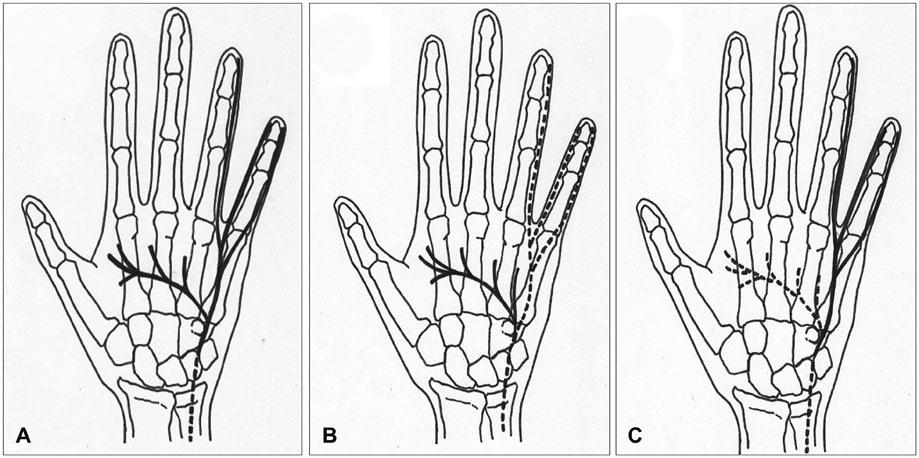 Guyon’s Canal Syndrome