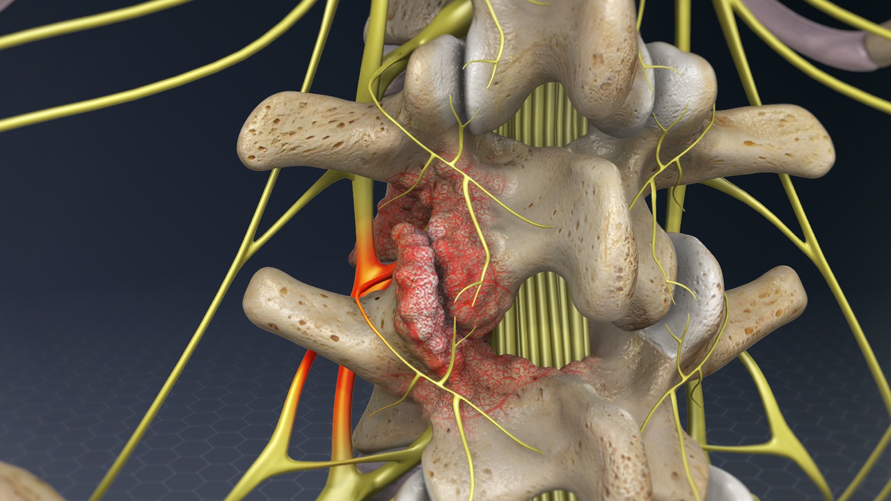 Cervical Foraminotomy