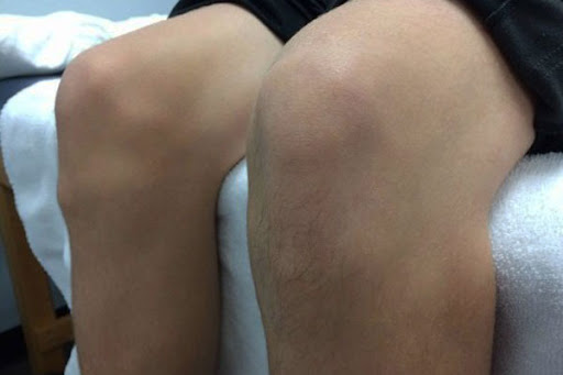 Jumper’s Knee in Children and Adolescents