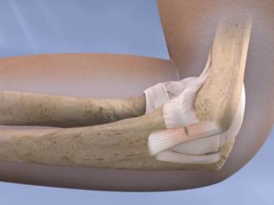 Ulnar Collateral Ligament Reconstruction of the Elbow