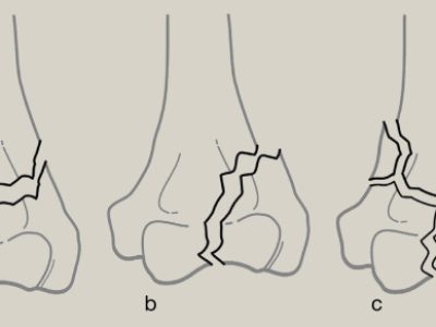 Supracondylar and Intercondylar Humeral Fractures