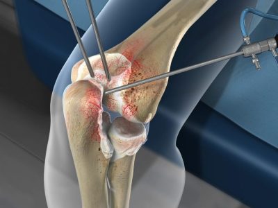 Open and Arthroscopic Treatment of Lateral Epicondylitis (Tennis Elbow)