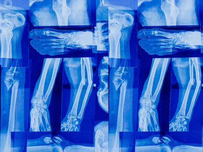 Simplifying the complex: complex bone fractures explained