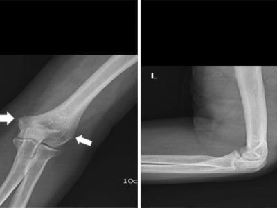 Radial Head and Neck Fractures