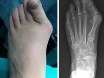 Bunion Surgery