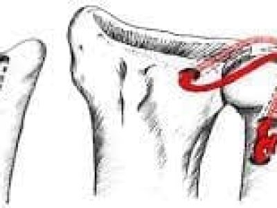 Distal Radioulnar Ligament Reconstruction