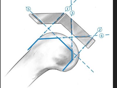 Surgical Lines in Total Knee Arthroplasty (TKA)