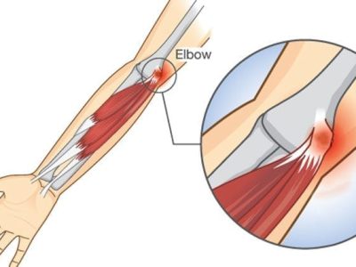 Open Treatment of Medial Epicondylitis (Golfer’s Elbow)