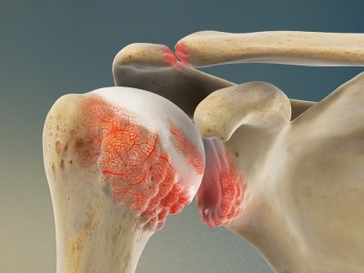 AC Joint Osteoarthritis