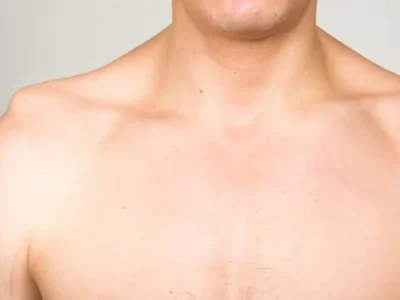 Acromioclavicular Joint Injuries