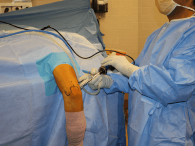 Arthroscopic Treatment of Cartilage Injuries and Osteochondritis Dissecans