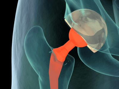 Advancements in Bone and Tissue   Transplantation Techniques