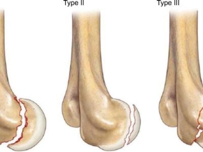 Capitellum and Capitellar-Trochlear Shear Fractures