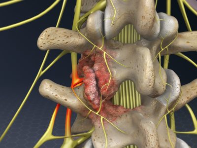 Cervical Foraminotomy