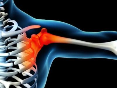 Fracture-Dislocations of the Shoulder