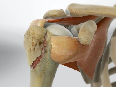 Fractures of the Greater Tuberosity