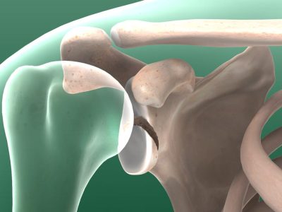 Glenoid Fossa Fractures
