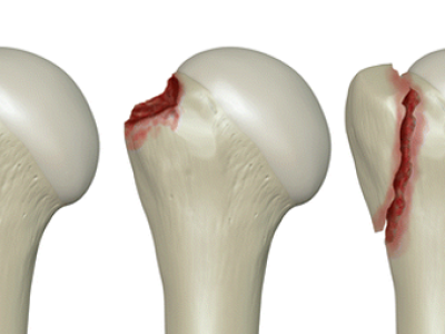 Greater Tuberosity Fractures