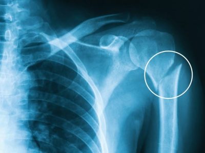 How to Identify and Treat Stress Fractures in the Arm