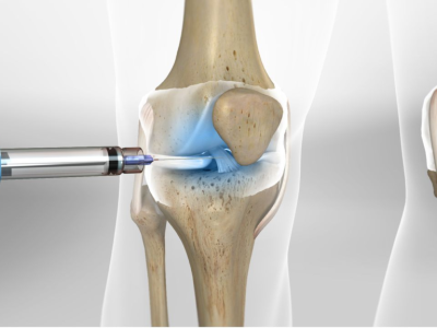 Joint Injections for Arthritis