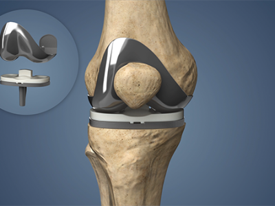 Understanding Knee Replacement Implants: Types and Benefits