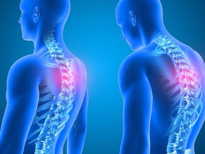 Understanding Kyphosis (Roundback) of the Spine