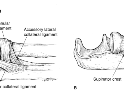 Lateral Collateral Ligament Reconstruction of the Elbow