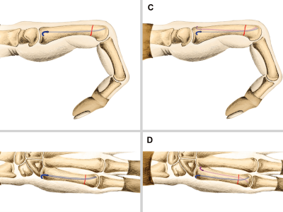 Metacarpal Fractures