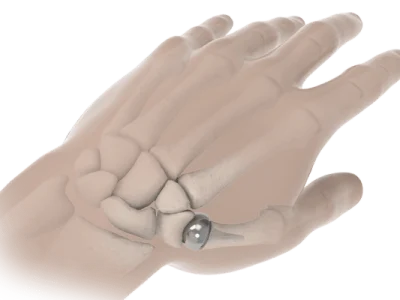 Thumb Osteoarthritis: Complete Guide to Joint Replacement