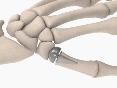 CMC Joint Replacement: Insights for Healthcare Professionals