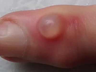 Mucous Cysts of the Fingers