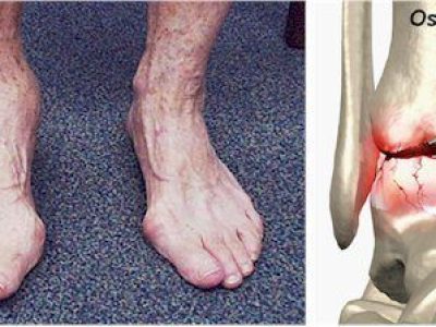 Osteoarthritis of the Ankle