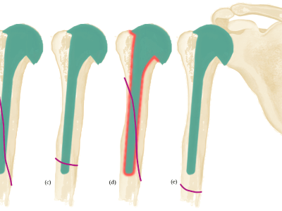 Periprosthetic Glenoid Fractures
