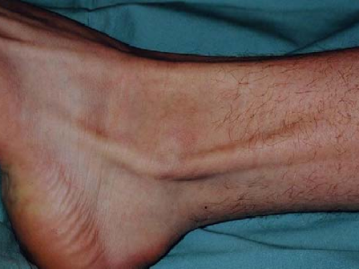 Peroneal Tendon Subluxation