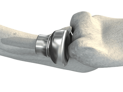 Radial head replacement