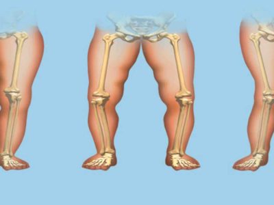 Rickets: Causes, Symptoms, Diagnosis, and Treatment