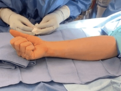 Complications following surgery