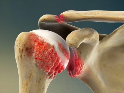 Shoulder Arthritis