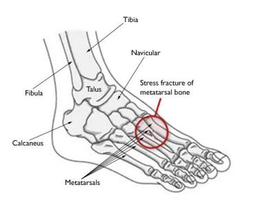 Understanding and Managing Stress Fractures in the Foot and Ankle