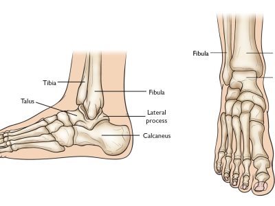 Understanding Talus Fractures: Causes, Treatment, and Potential Complications