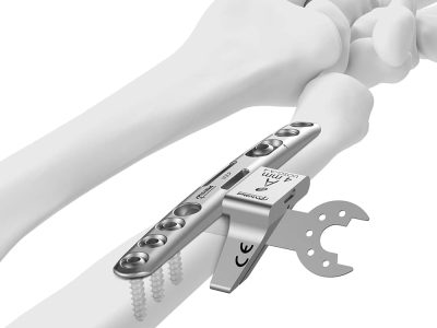 Ulnar Shortening Surgery