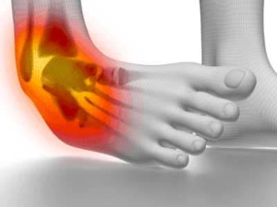  Understanding Ankle Fractures    