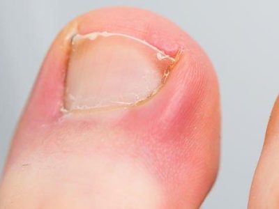 Understanding and Preventing Ingrown Toenails: Causes and Solutions